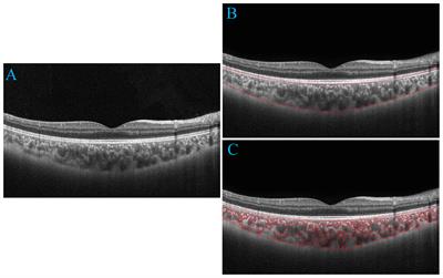 Vascular changes of the choroid and their correlations with visual acuity in diabetic retinopathy